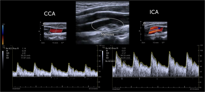 12-carotid-artery-stenosis-part-2-spectral-doppler-123-sonography